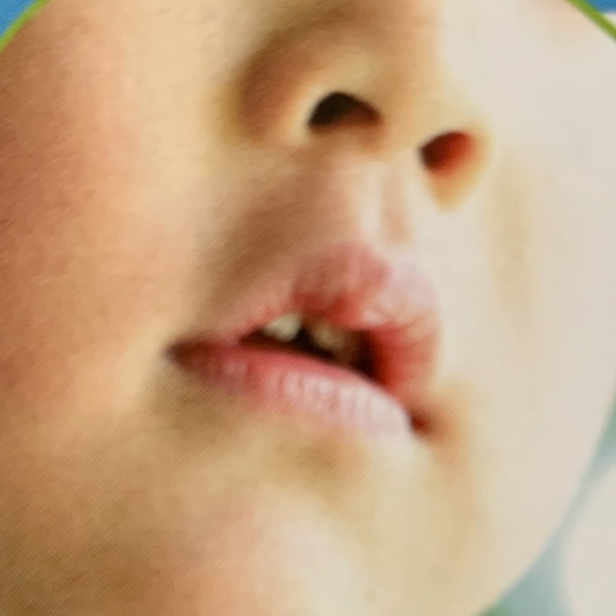 お子様のお口ぽかんの治療