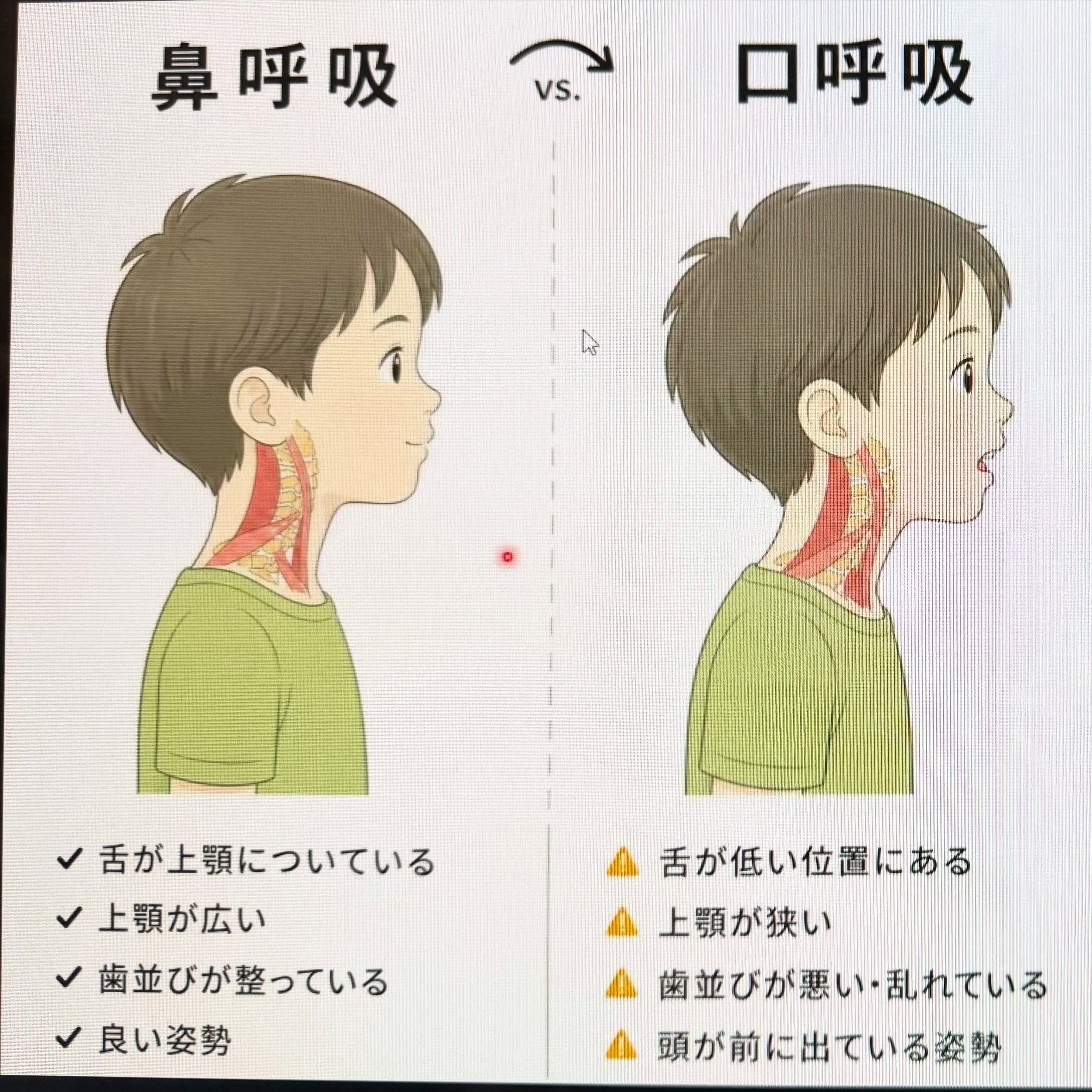 顎の成長不足と歯並びの成長